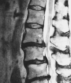 脊柱管狭窄症の起こる原因